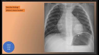 OSCE Case 018  Round Pneumonia [upl. by Eniawed]