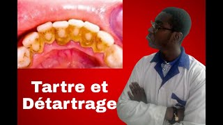 Le tartre et le détartrage [upl. by Pell]