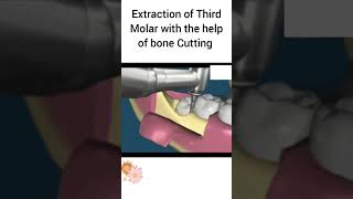 Extraction of Third Molar with the help of bone Cutting oralsurgery [upl. by Layap]