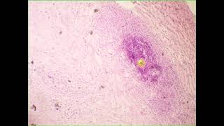 Mucoid embryonal c t Umbilical cord [upl. by Weisman]