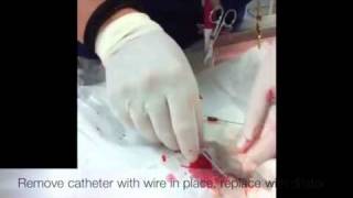 Placing a jugular catheter [upl. by Craw]