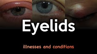 Eyelid Illnesses and Conditions [upl. by Yddub]