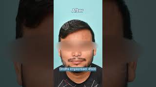 Before After of Hair Transplant Result with 4500 Grafts shortsviral naturalhairline hairgrowth [upl. by Ssidnak]