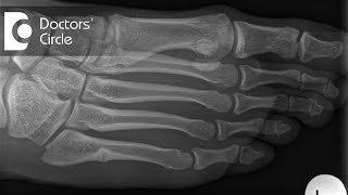 What should one do to speed up the recovery post surgery for Metatarsal Fracture  Dr Mohan M R [upl. by Agatha]