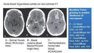 Subarachnoid Haemorrhage [upl. by Alet]