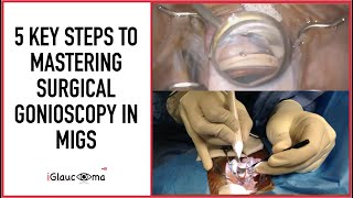 5 Key Steps to Mastering Surgical Gonioscopy in MIGS [upl. by Margaret]