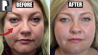 Blepharoplasty Review amp Testimonial [upl. by Khalsa]