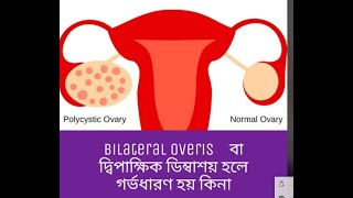 Bilateral polycystic Overies বা দ্বিপাক্ষক ডিম্বাশয় হলে গর্ভধারণ হয় কি না [upl. by Tennaj]