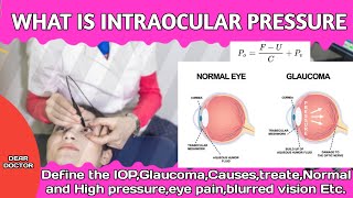 WHAT IS INTRAOCULAR PRESSURE CAUSES AND TREATE [upl. by Kilmarx]