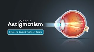 What is Astigmatism Symptoms Causes amp Treatment Options [upl. by Naasah632]