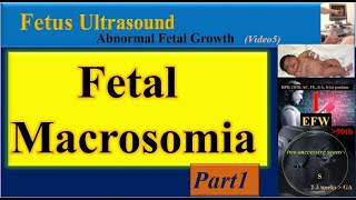 Fetus Ultrasound Fetal Macrosomia Part1 [upl. by Ruthy]