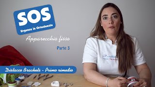 SOS Apparecchio Fisso  Distacco brackets  Primo rimedio [upl. by Aohsoj]