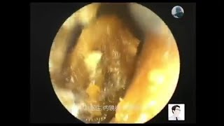 Clearance of external ear canal earwax and external auditory canal cholesteatoma for 14 minutes [upl. by Alviani480]