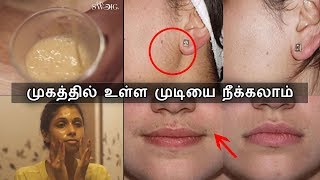 முகத்தில் உள்ள தேவையற்ற முடியை எளிதாக நீக்கிவிடலாம்  Unwanted Facial hair removal  Say Swag [upl. by Joacima]