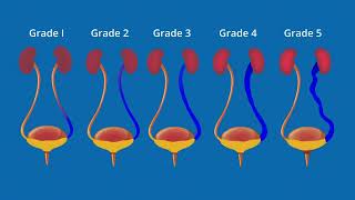 What is Vesicoureteral Reflux VUR [upl. by Ligetti]