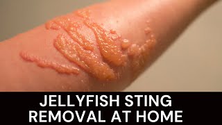 Jellyfish Sting Removal How  JellyFish Sting Removal Remedies [upl. by Eetsud468]