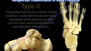 Navicular Fractures  Everything You Need To Know  Dr Nabil Ebraheim [upl. by Ravilob]