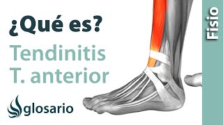 TENDINITIS DEL TIBIAL ANTERIOR  ¿Qué es [upl. by Nial930]