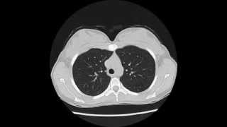 Normal Chest CT  using quotlung windowsquot [upl. by Leacim376]