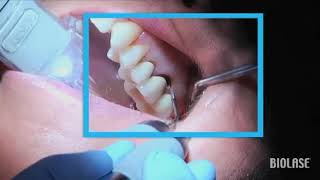 Remoción de caries con lasers Biolase  Streamhealth Dental [upl. by Naitsirhc]