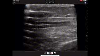 USM  Catheter Thrombi [upl. by Aline]