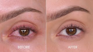 WOW  How To Remove Eye Redness In Minutes  Shonagh Scott [upl. by Silvester]