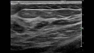 Breast Ultrasound  fat and glandular tissue [upl. by Essirehc790]