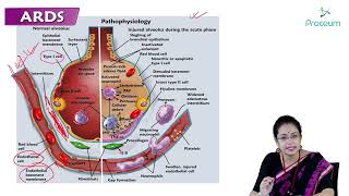 Acute Respiratory Distress Syndrome ARDS Part 1  Internal medicine 🫁🫁🫁 [upl. by Woolson]