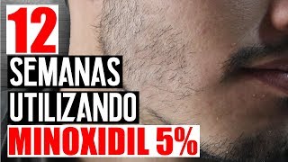 RESULTADOS CON MINOXIDIL 5  12 SEMANAS  JR Style For Men [upl. by Hailahk]