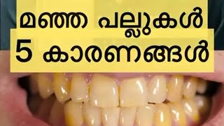 മഞ്ഞ പല്ലിന്റെ 5 കാരണങ്ങൾ 5 reasons for yellow teeth yellowteeth healthvideos teethwhitening [upl. by Yurik]