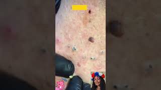 💙 Best Satisfying Blackhead Removal  Pimple Popping Blackheads amp White Heads Removal From Nose [upl. by Nais]