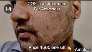 I got franctional CO2 Laser Treatment for Acne Scars  first sitting  Before After Results [upl. by Bobker]