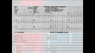 12 Lead Interpretation Part 62 EKG Changes and Lead Localization of Myocardial Infarctions [upl. by Lamrej3]