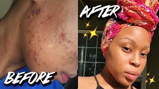 ✨MY SKINCARE ROUTINE  HOW I CLEARED MY HORMONAL ACNE✨ [upl. by Enomaj809]