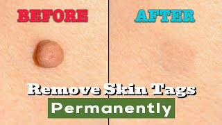 5 Fast Home Remedies to Remove Skin Tags amp Warts [upl. by Selby]