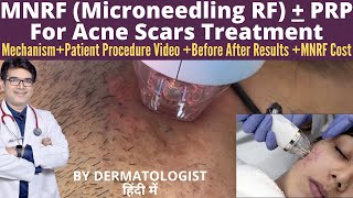 Microneedling RF MNRF Treatment For Acne Scars  MNRF Skin Treatment with PRP  Before After Results [upl. by Ahseirej49]