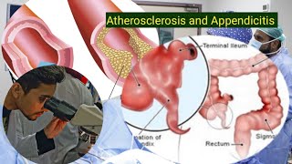 Atherosclerosis and Appendicitis medical pathology nursing [upl. by Trinette72]