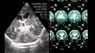 VSCAN Pocket Ultrasound Transfontanelar Hydrocephalus Hidrocefalia [upl. by Ober753]