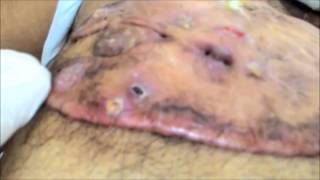 A Big Keloid covering entire chest with ulceration Chronic Keloid Hypertrophic scar क्षतांक [upl. by Kiryt835]