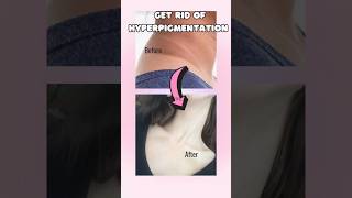 How to get rid of hyperpigmentation on the neck [upl. by Aruat]