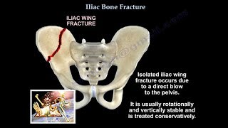 Iliac Bone Fracture  Everything You Need To Know  Dr Nabil Ebraheim [upl. by Harcourt466]