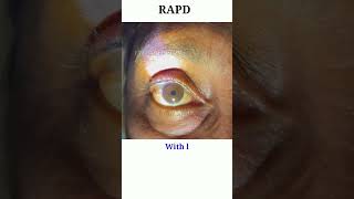 RAPD testing  Optic nerve test  Swinging flash light test eyecareoptom shorts rapd short eye [upl. by Codi]