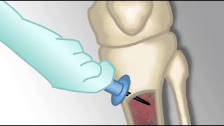 quotPlacement of an Intraosseous Linequot by Monica Kleinman MD for OPENPediatrics [upl. by Modesty]