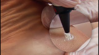 Plantar Wart Treatment [upl. by Chally201]