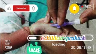 Cannulation technique Newborn baby cannula nicu injection [upl. by Llevad]