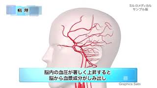 高血圧性脳症／ミルメディカル 家庭の医学 動画版 [upl. by Esylla]