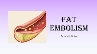 Ortho Fat embolism vs fat embolism syndrome  Gurds criteria Schonfelds criteria management [upl. by Anawak]