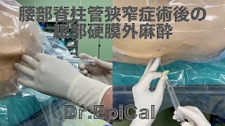 腰部脊柱管狭窄症術後の腰部硬膜外麻酔 epidural anesthesia by DrEpiCal [upl. by Oys]