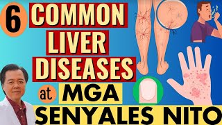 6 Common Liver Diseases at Mga Senyales Nito  By Doc Willie Ong Internist and Cardiologist [upl. by Orvan]