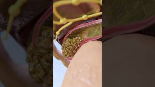 3D liver pathology  cholesterol gallstones in cholelithiasis 3danatomy [upl. by Sanez377]